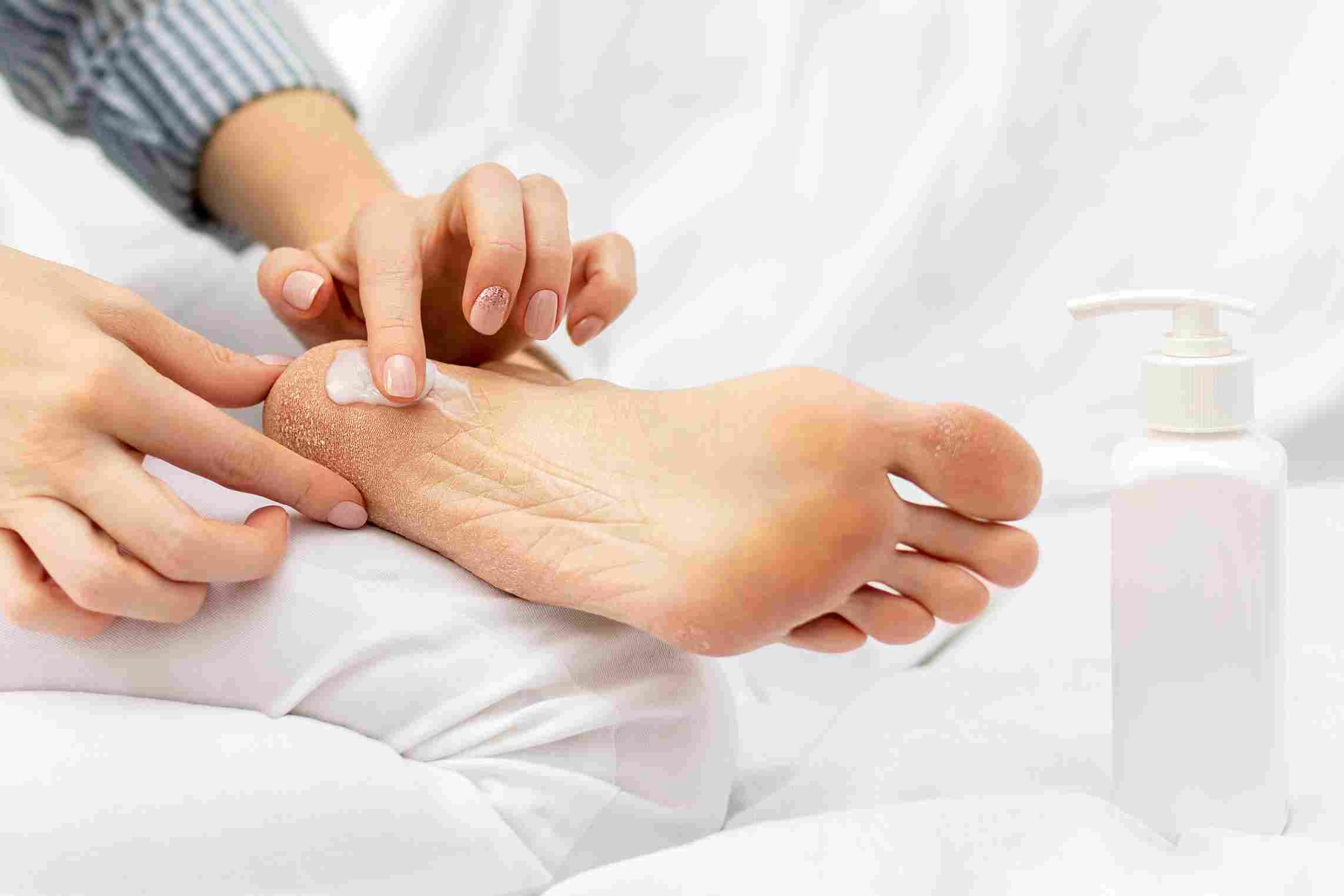 5 Obat Terbaik untuk Menghilangkan Kaki Pecah-Pecah